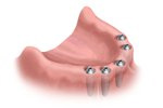 Installing Dental Implants in Medford, OR